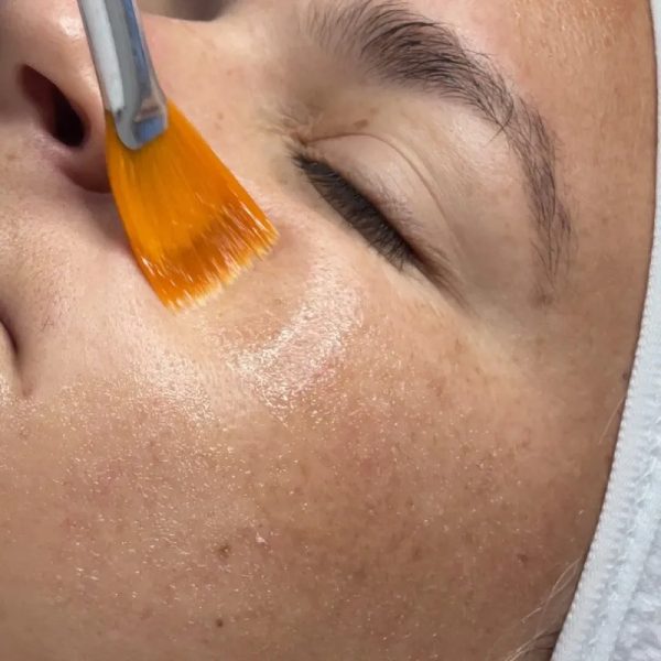 Peeling Químico