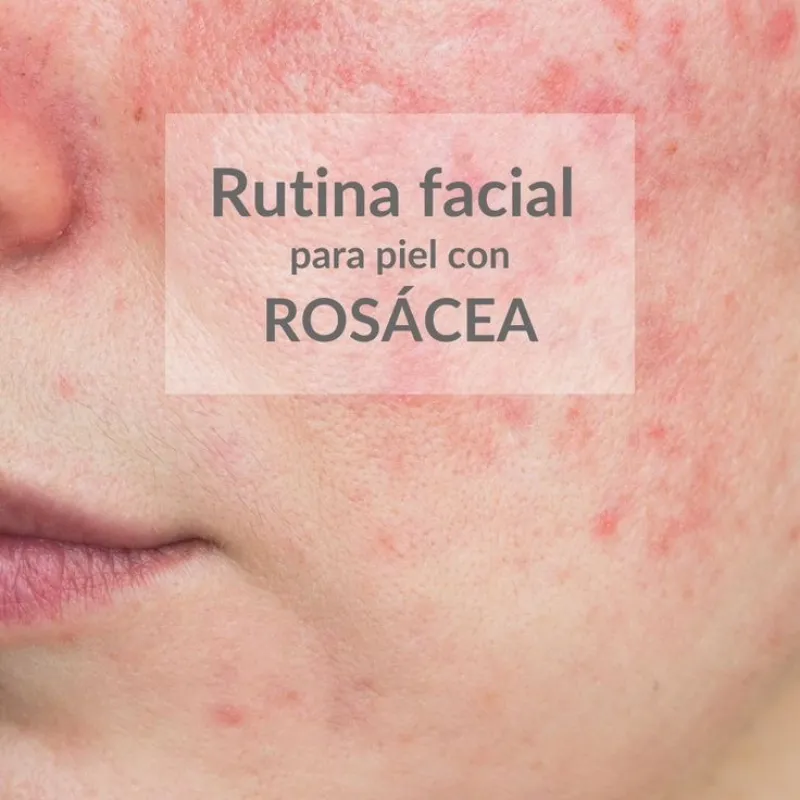 Tratamientos para pieles con rosácea