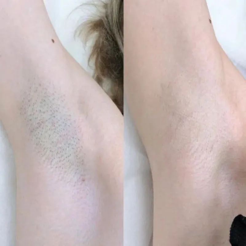 Depilación de axilas