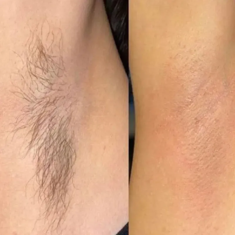 Depilación de axilas