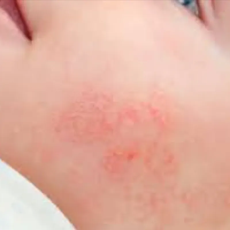 Dermatitis. Acné o Alopecia