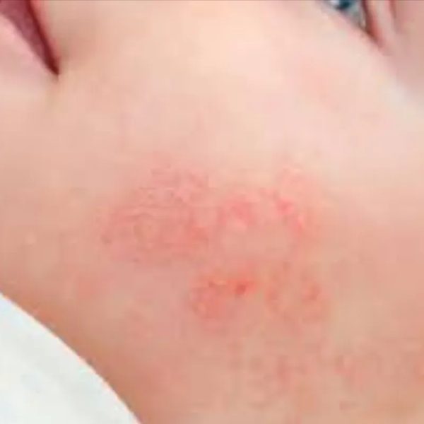 Dermatitis. Acné o Alopecia