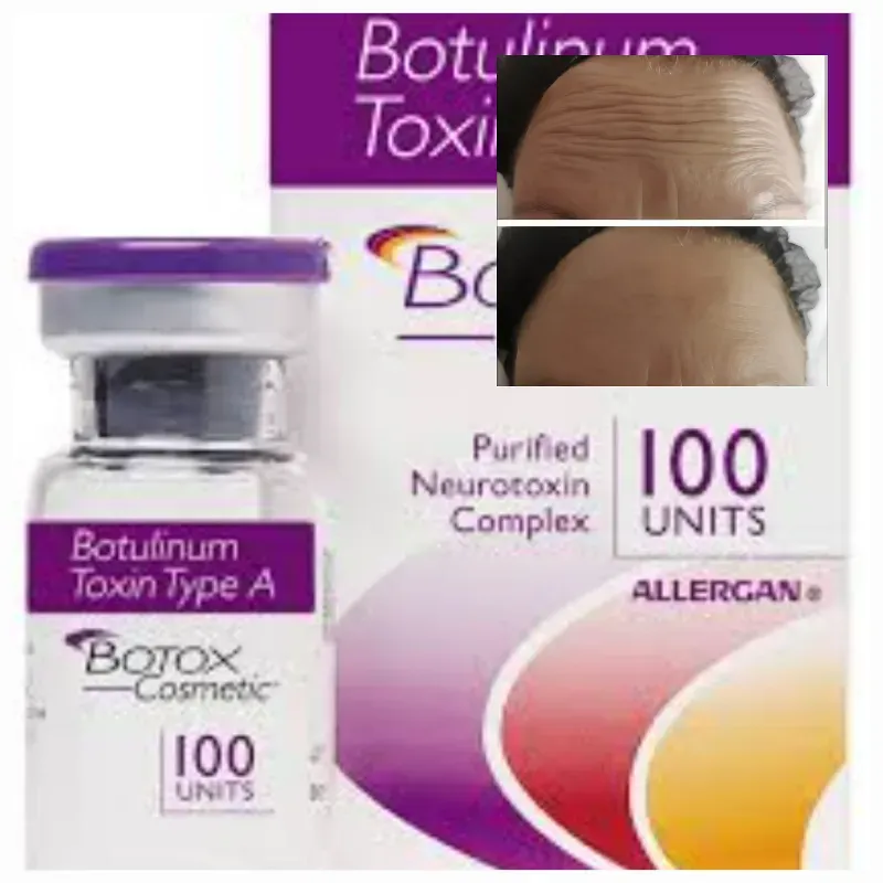 Toxina butulinica ( Bótox)