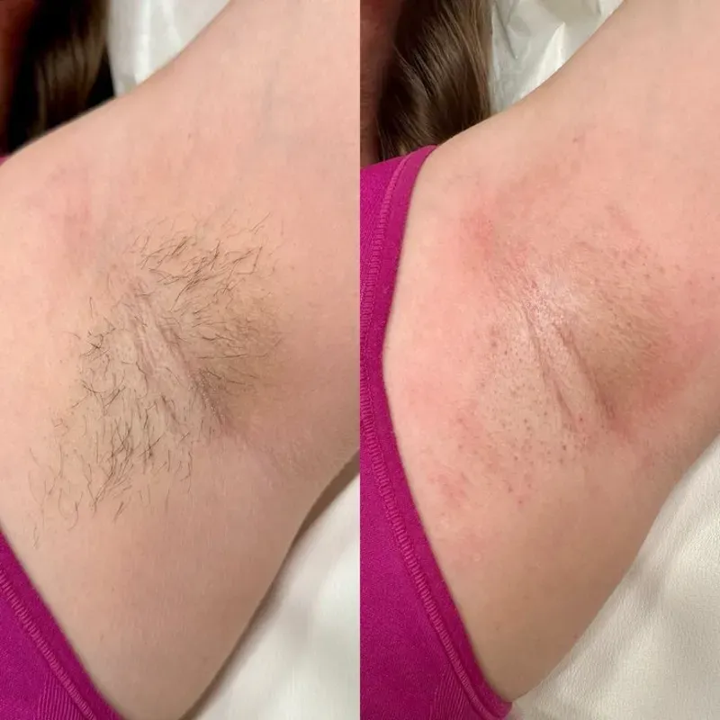 Depilación de axilas