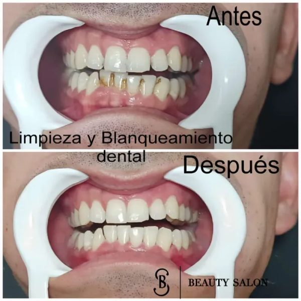 Combo Dental ( Limpieza + Blanqueamiento )