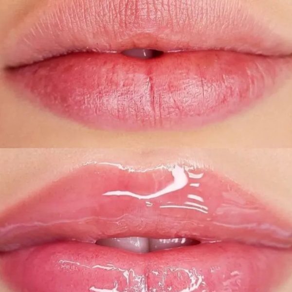 Hydralips con dermapen