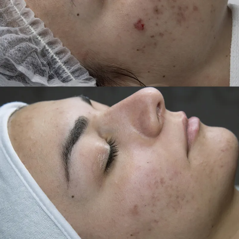 Terapia de Microagujas para marcas de acné