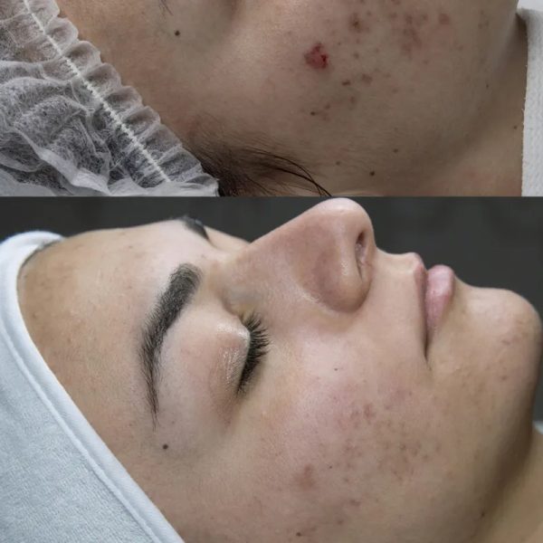 Terapia de Microagujas para marcas de acné