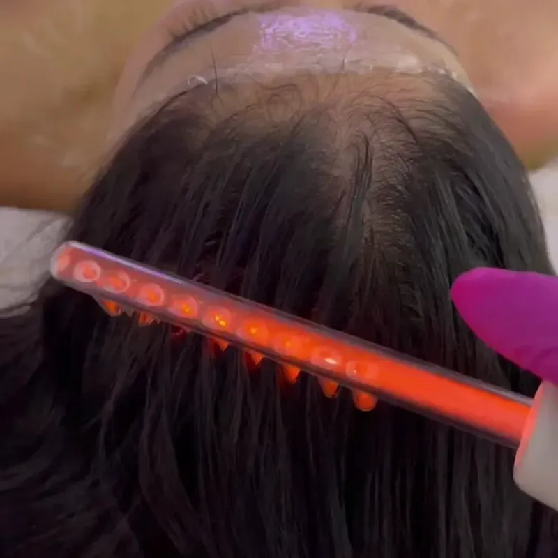 Alta frecuencia capilar