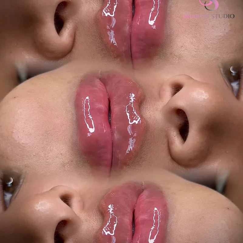 Aumento de Labios