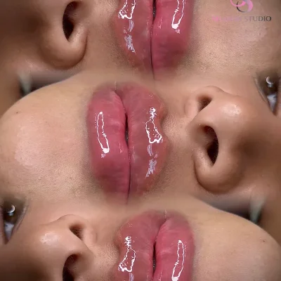 Aumento de Labios