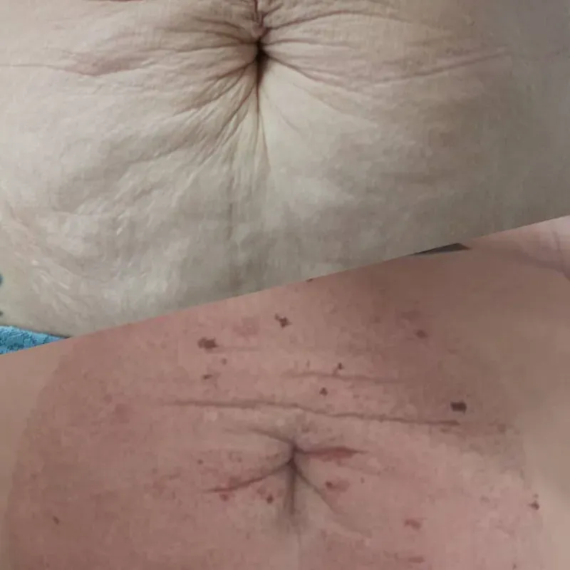 Fibroblast para estrías blancas