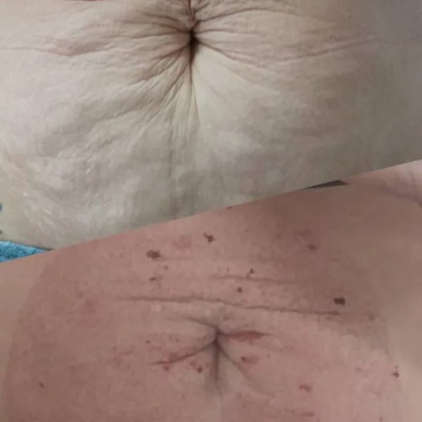 Fibroblast para estrías blancas