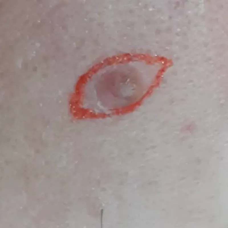 Exéresis de verrugas y quistes cebáceos