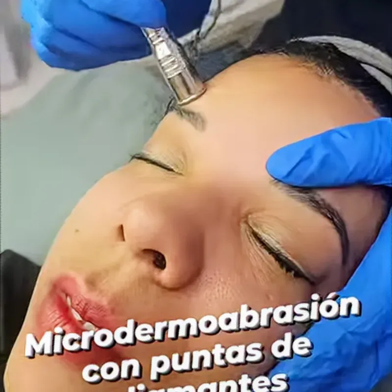 Microdermoabrasión con punta de diamante