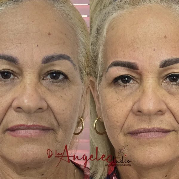 Botox Full Face.