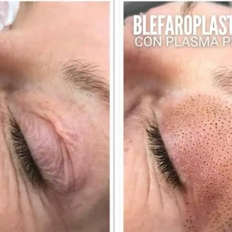 LEVANTAMIENTO DE PÁRPADOS SUPERIORES ( BLEFAROPLASTIA)