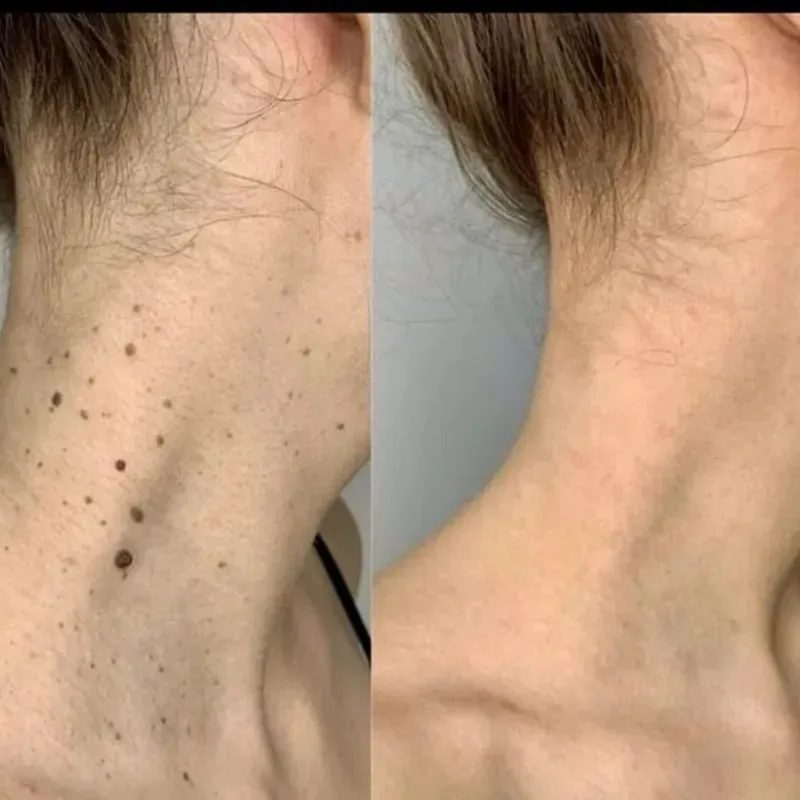 Eliminación de verrugas, lunares o pecas con plasma pen