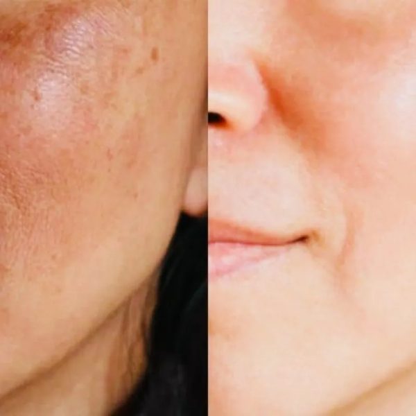 Facial antimanchas