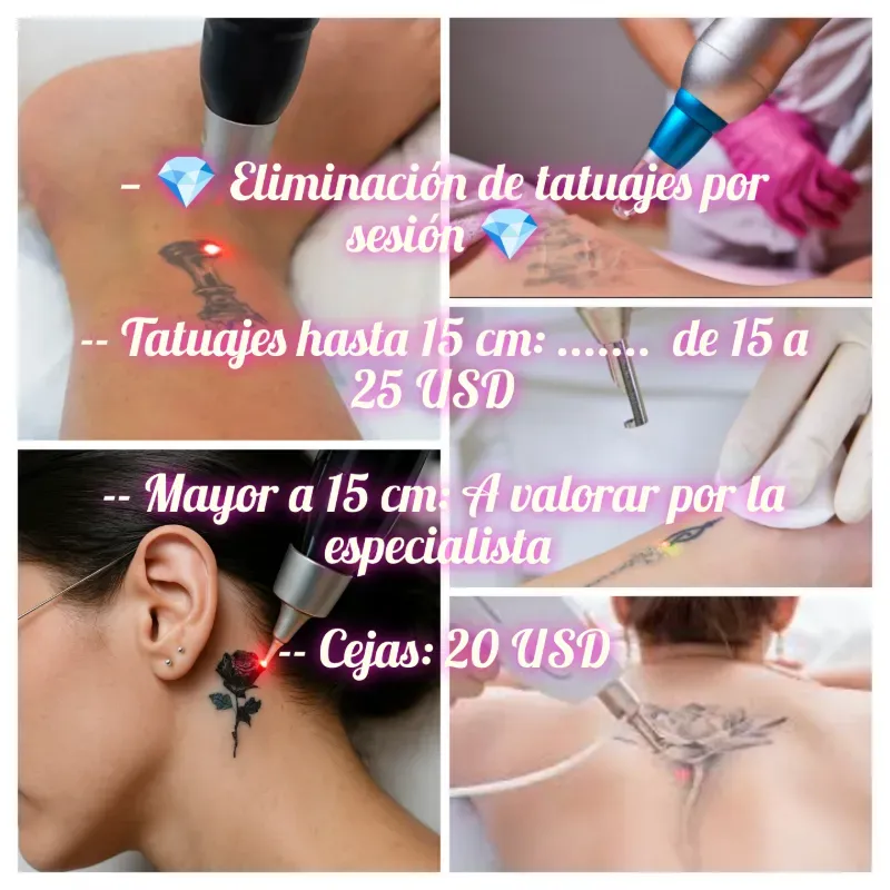  Eliminación de tatuajes con láser