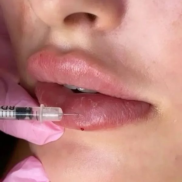  Aumento de Labios (Filler Lips)