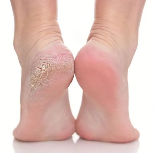 Tratamiento anti callosidad para los pies