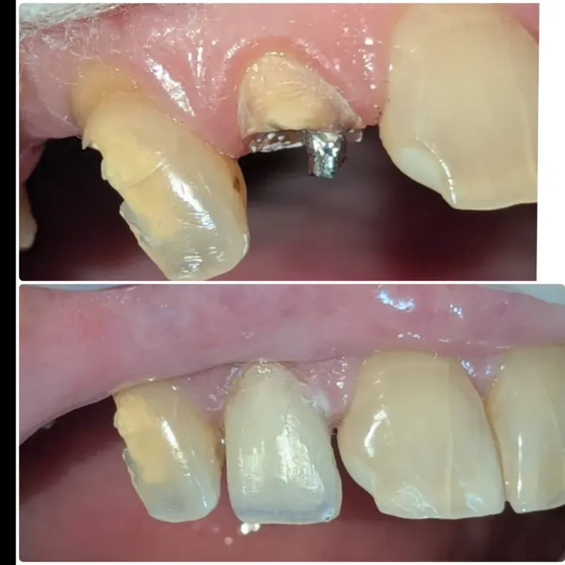 Restauración con Espiga