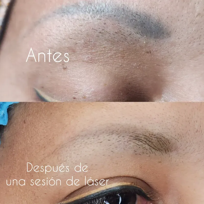 Remoción de Tatuaje de Cejas con Lasér.