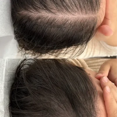 Tratamiento para la caída del cabello.