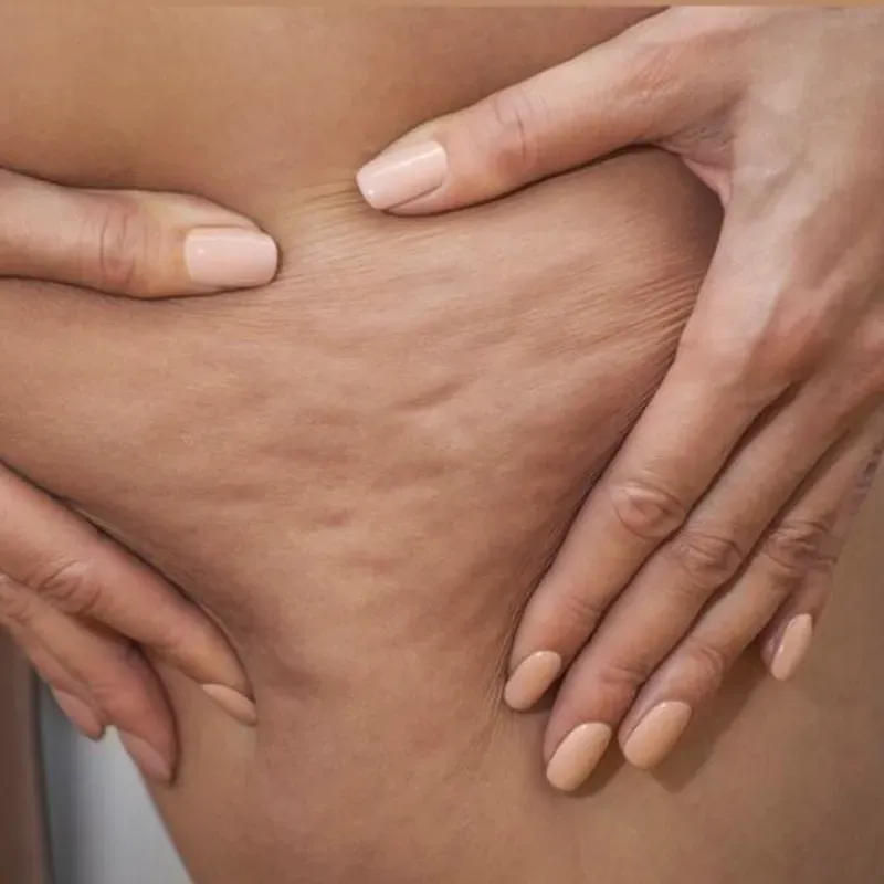 Masaje Anticelulítico