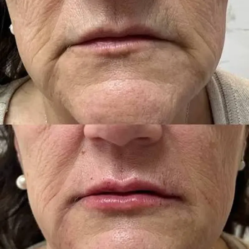 ELIMINACIÓN O DISMINUCIÓN DE SURCOS NASOGENIANOS Y PERIBUCALES