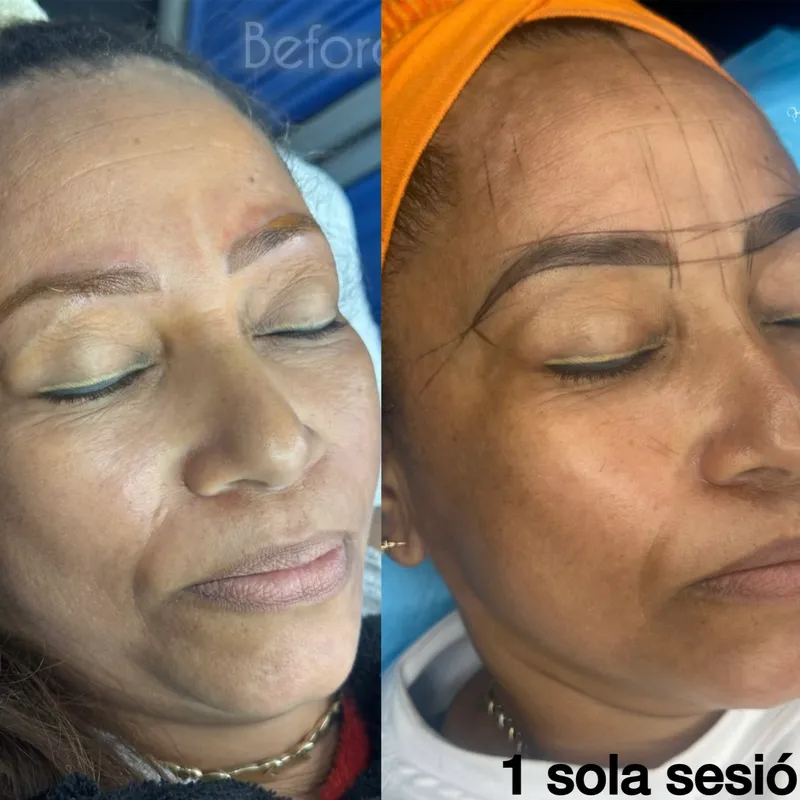 BIOMICRONEEDLING_Microagujas Biológicas