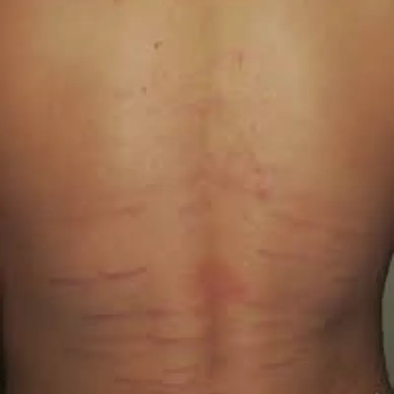 TRATAMIENTO DE ESTRÍAS EN ESPALDA