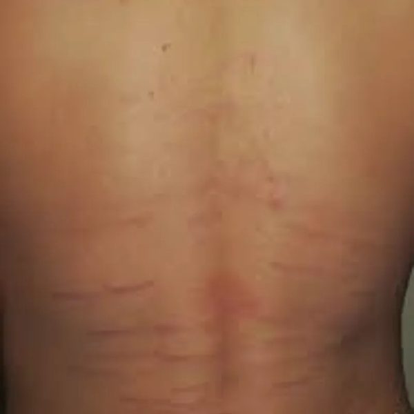 TRATAMIENTO DE ESTRÍAS EN ESPALDA