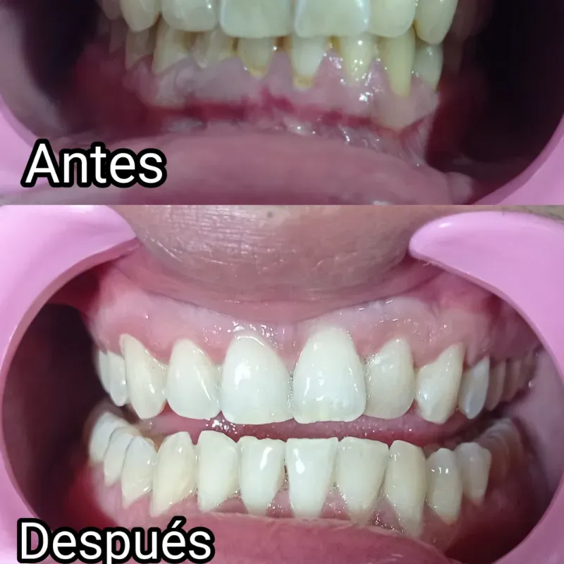 Blanqueamiento dental