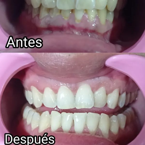 Blanqueamiento dental