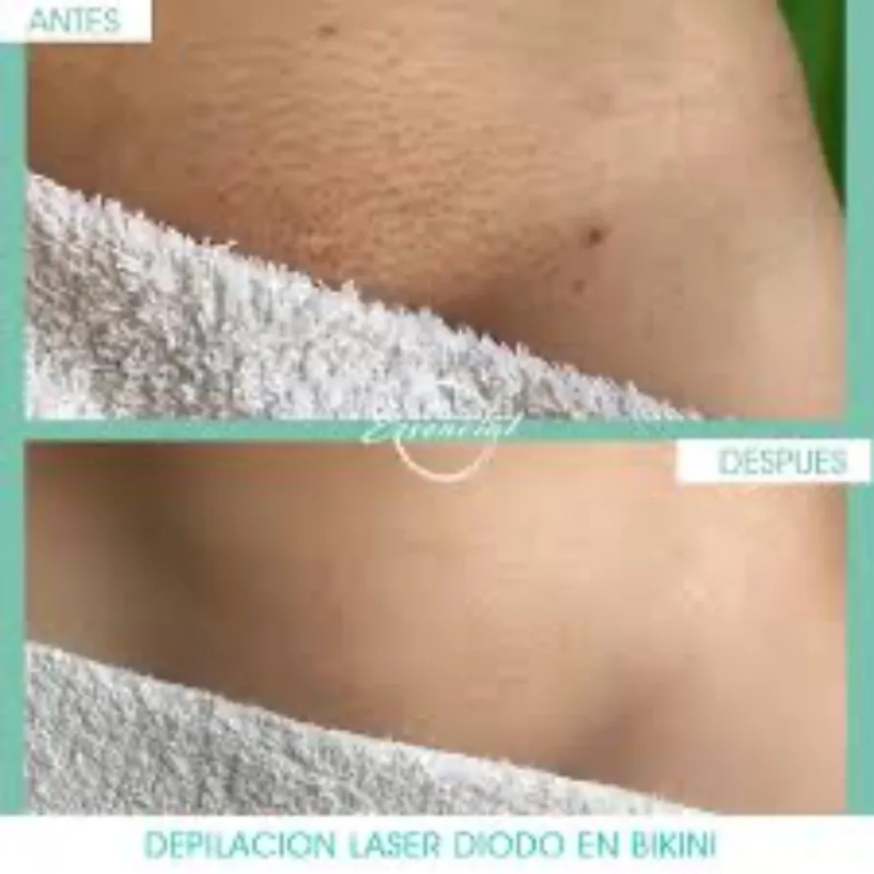 Brasileño (genital femenino)