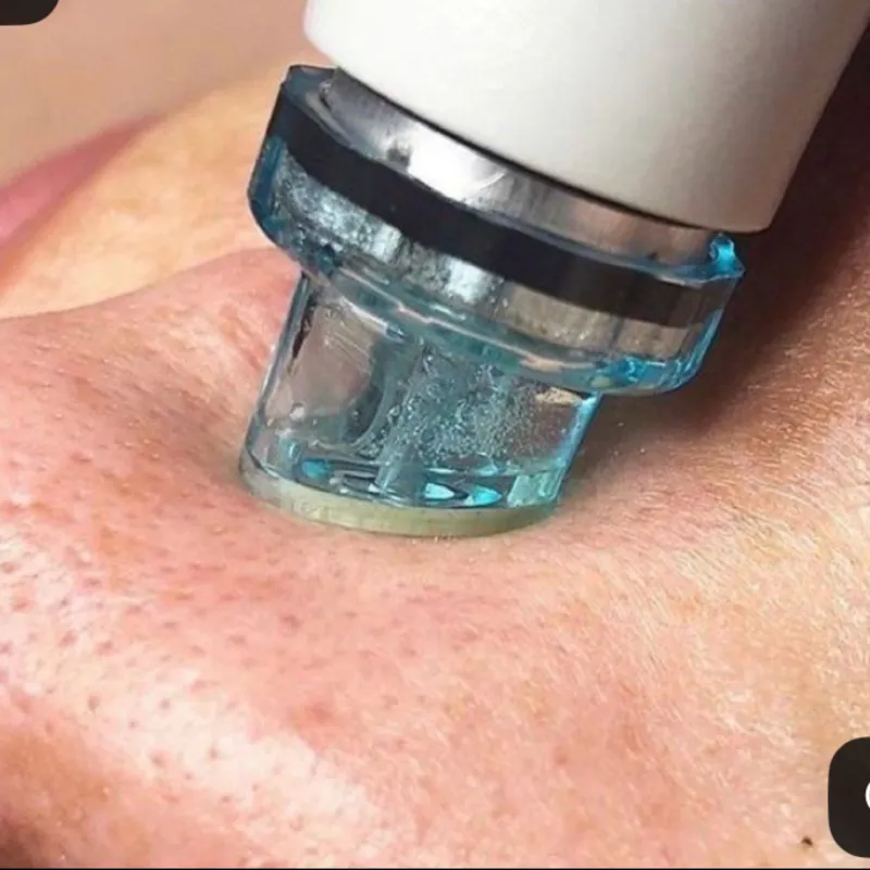 Limpieza facial profunda con hidrodermoabrasión y crioterapia activa.