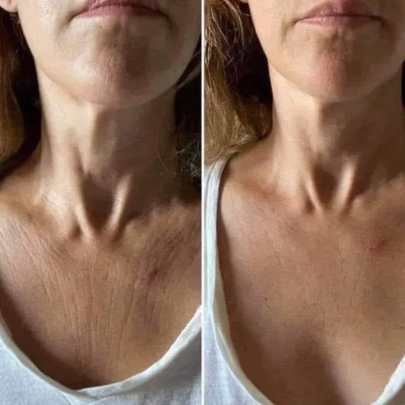 2000 pesos Tratamiento para Cuello y Escote
