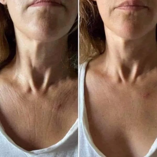 2000 pesos Tratamiento para Cuello y Escote