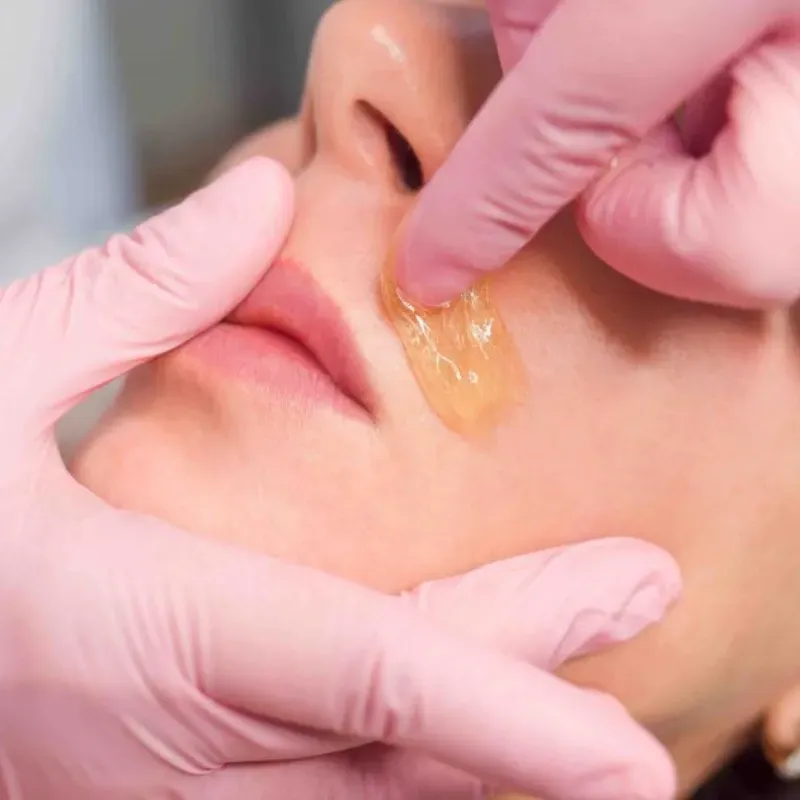 Upper lip and chin hair removal with wax