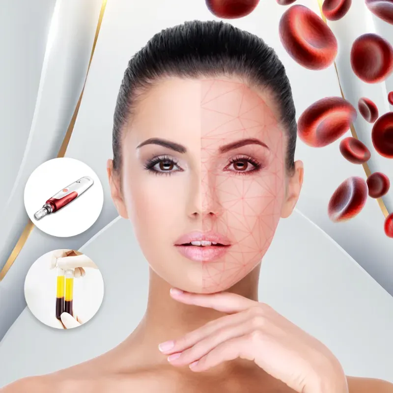 Plasma rico en plaquetas.