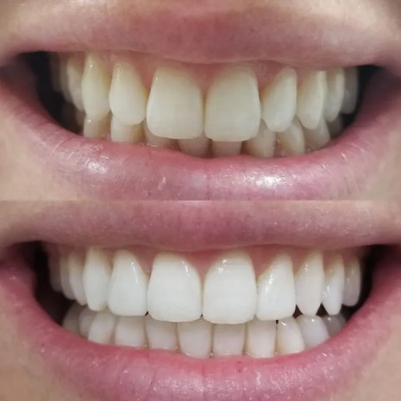 Limpieza Bucodental + Blanqueamiento dental