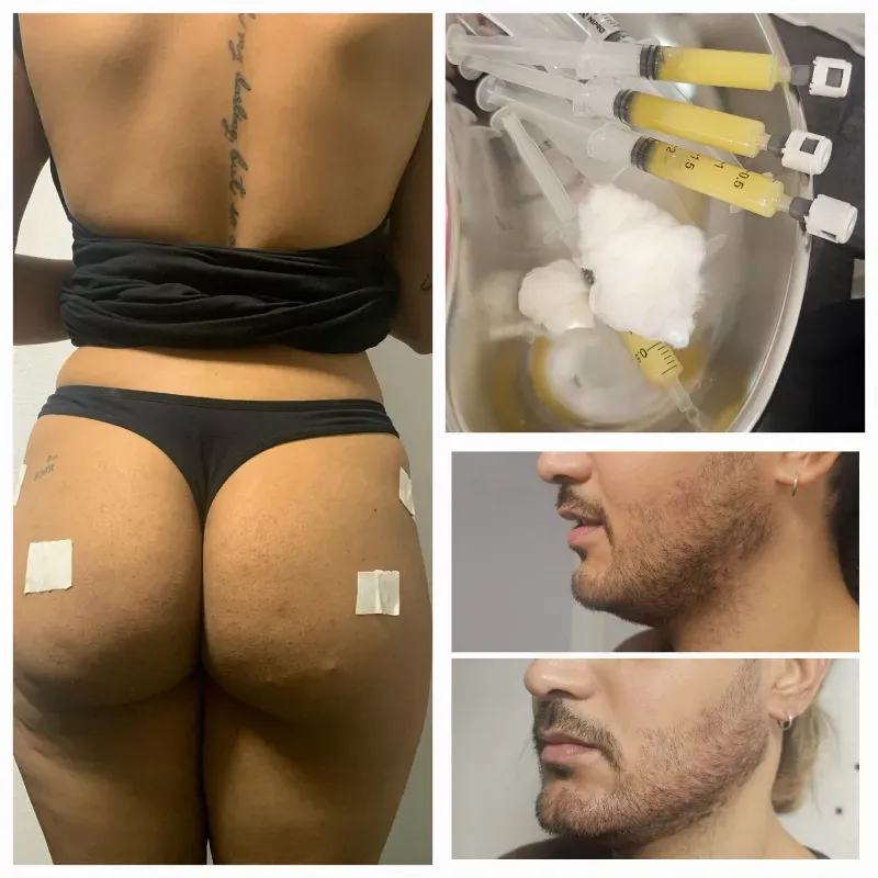 Plasma Gel 