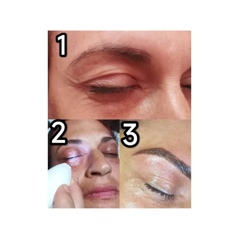 Fibroblast contornos ojos, labios, cuello o manos (precio por zona a tratar)