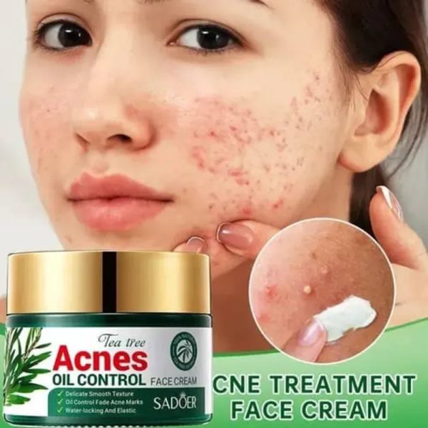 Crema Anti-Acné