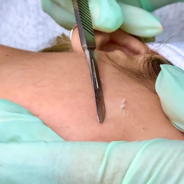 DERMAPLANING CON ACTIVOS