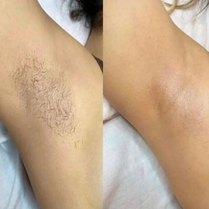 Depilación con Cera