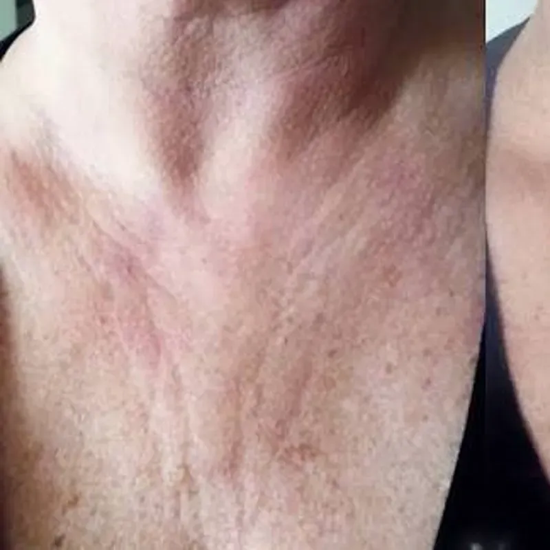 TRATAMIENTO DE ARRUGAS Y LÍNEAS DE EXPRESIÓN EN CUELLO Y ESCOTE