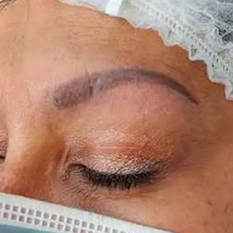 ELIMINACIÓN DE MICROPIGMENTACIÓN DE CEJAS